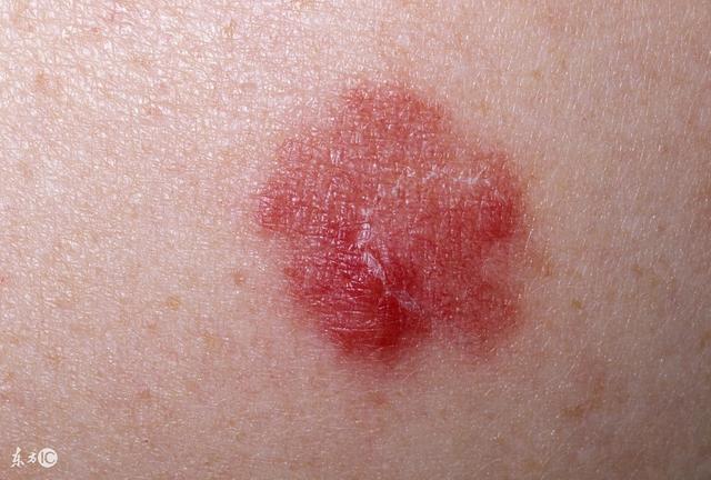 丘疹怎么护理才好得快,丘疹需要注意的饮食