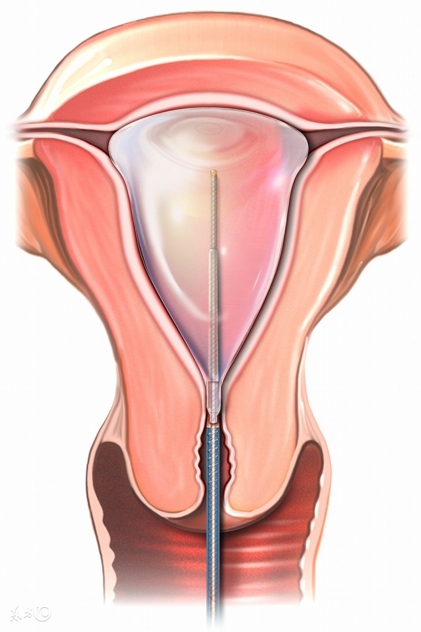 如何发现宫颈肥大，它的症状及病因又是什么