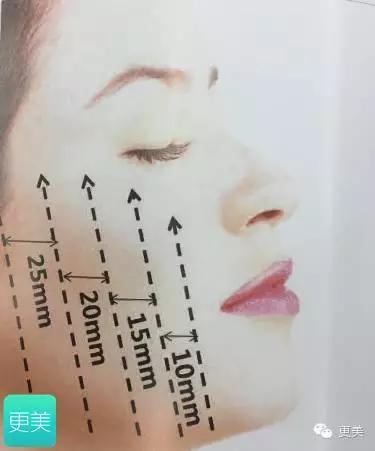 脸部缝美容线好还是普通线好,医院埋线和美容院埋线有什么差别