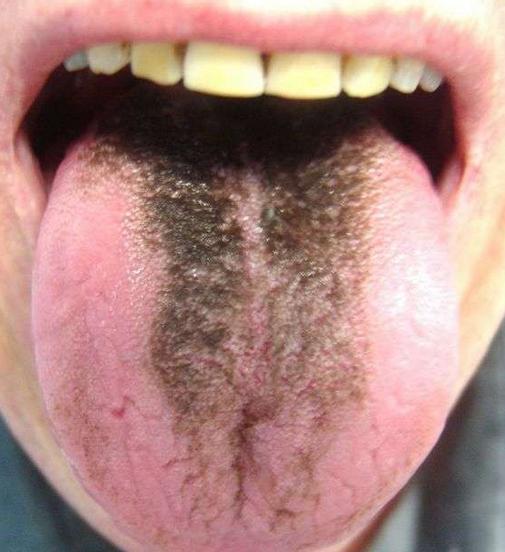 舌头有点皱证明什么,舌头边缘褶皱是什么原因