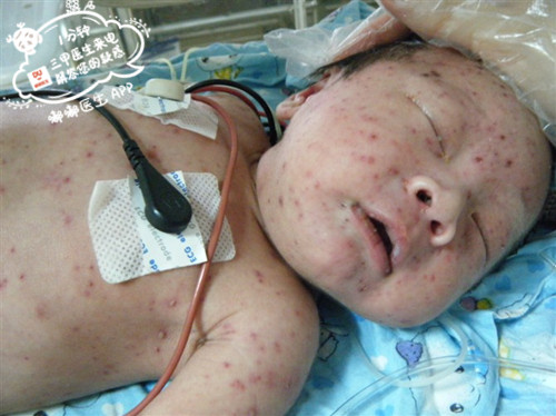 出生15天宝宝脸上起痘痘原因,生水痘的宝宝