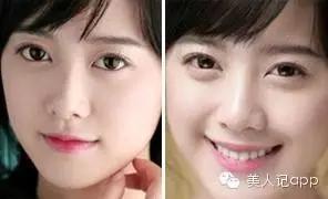 怎么区分眼袋黑眼圈泪沟卧蚕,卧蚕眼袋泪沟黑眼圈