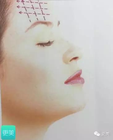 脸部缝美容线好还是普通线好,医院埋线和美容院埋线有什么差别