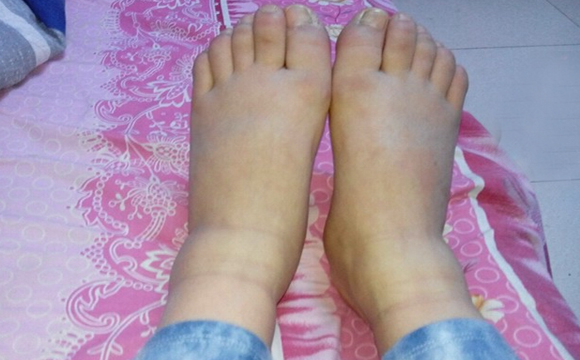 孕期手疼脚肿腿抽筋真的很无助,孕妇怀孕36周脚腿抽筋是怎么了