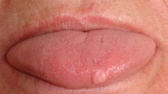 舌头有点皱证明什么,舌头边缘褶皱是什么原因