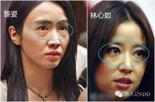 怎么区分眼袋黑眼圈泪沟卧蚕,卧蚕眼袋泪沟黑眼圈