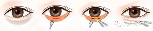 怎么区分眼袋黑眼圈泪沟卧蚕,卧蚕眼袋泪沟黑眼圈