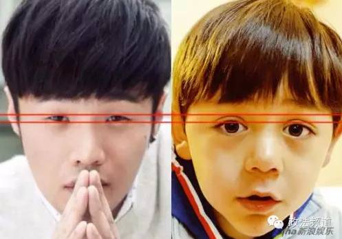 宁乡女子整容割成“三眼皮”，出门只能带墨镜！