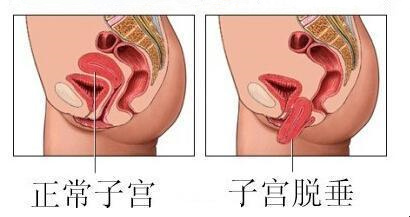 产后必读!常见病防治之子宫脱垂!