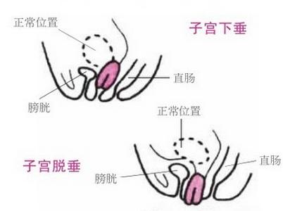 产后必读!常见病防治之子宫脱垂!