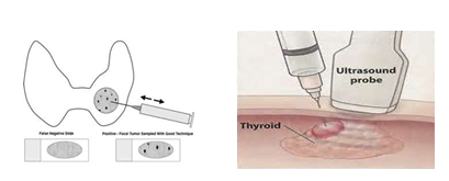 甲状腺超声介入射频疗法,甲状腺超声介入消融术