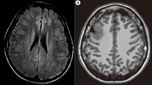 癫痫治疗最新医学动态,中医癫痫讲解视频