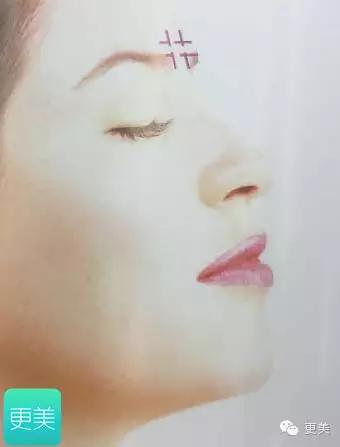 脸部缝美容线好还是普通线好,医院埋线和美容院埋线有什么差别