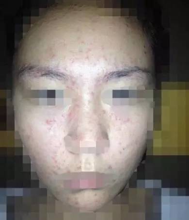 选面膜雷区,选面膜要避开哪些成分