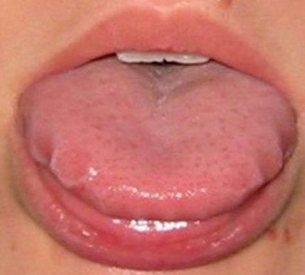 舌头有点皱证明什么,舌头边缘褶皱是什么原因