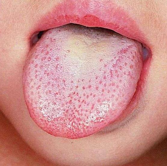 舌头有点皱证明什么,舌头边缘褶皱是什么原因