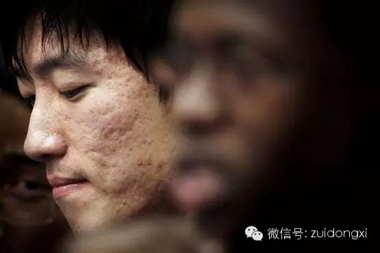 淡化痘印痘坑的5个小妙招,痘坑怎么治疗不会色素沉淀