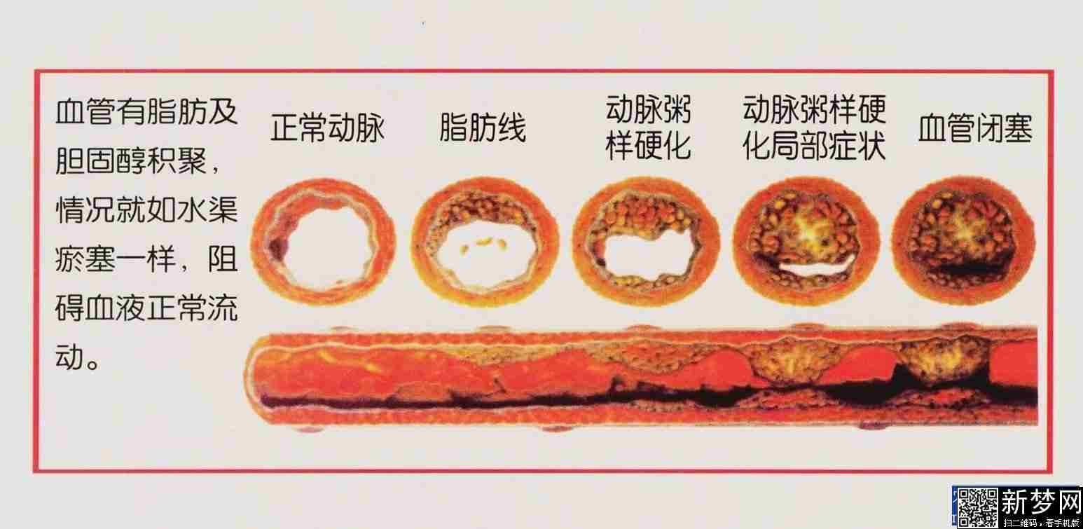 血管老化快寿命就短吗,血管特别细寿命就会短吗