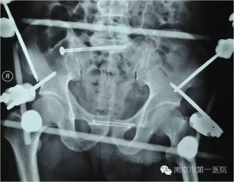 车轮碾压属于什么骨折,被车轮碾压是压缩性骨折吗