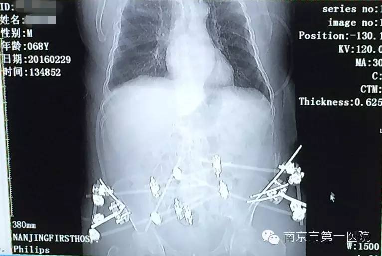 车轮碾压属于什么骨折,被车轮碾压是压缩性骨折吗