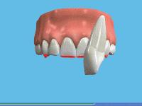 磨牙牙齿坏一半怎么补救,睡觉磨牙怎么用中医治疗