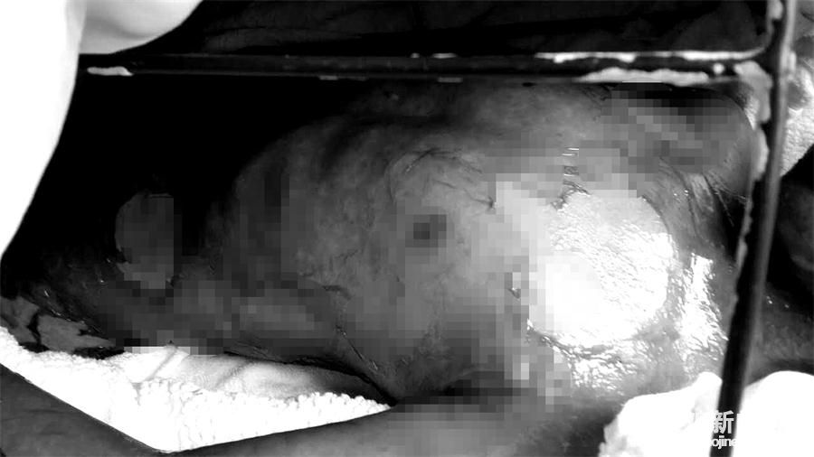 儿童抗疫情捐款,男童患罕见病急求助捐款