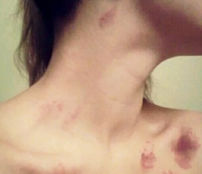 “致命”吻痕是如何形成的？