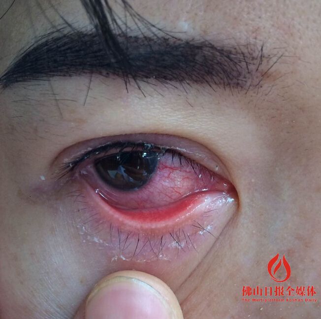 女子花两万元整容眼睛,女子花280元纹眉醒来后变4条