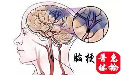 脑梗后遗症怎样控制血脂,腔隙性脑梗死应该吃哪些药