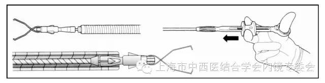 消化内镜护理配合教学视频,消化内镜取样钳