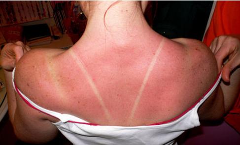 不小心被晒黑了怎么办,夏天被晒得肤色不均匀怎么办