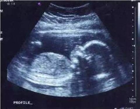 胎儿b超字母代表啥,胎儿b超单上的英文缩写