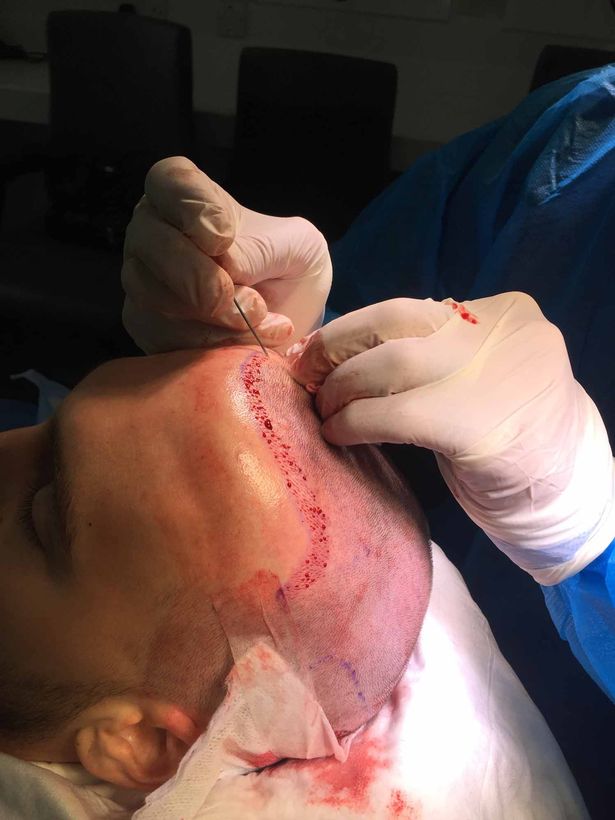 英国球星鲁尼植发,鲁尼植发真实视频