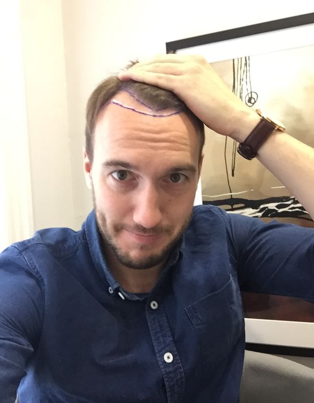 英国球星鲁尼植发,鲁尼植发真实视频