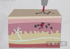 这样的文身，女孩涂后红疹起泡留疤都来了，你还敢玩吗？