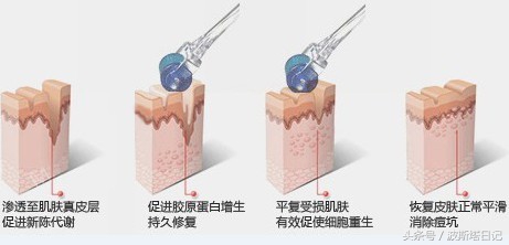 美塑微针真的有用吗,微针美塑有效果