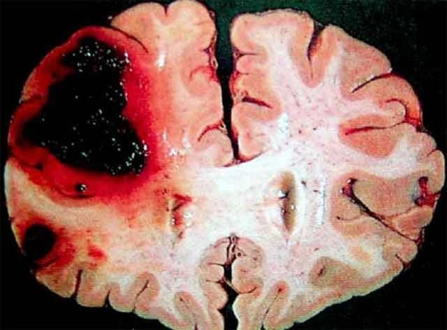 脑溢血很严重可以醒过来吗,高血压糖尿病脑出血会好起来吗