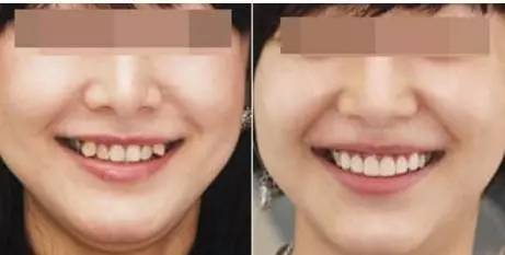 30岁淡化法令纹用什么精华,法令纹严重推荐精华