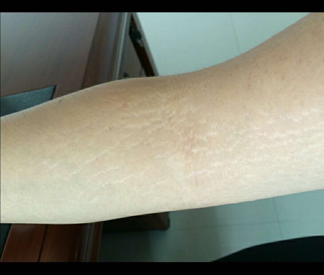 肥胖纹怎么消除产后,肥胖纹怎么消除涂什么药