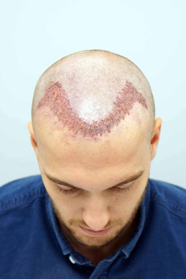 英国球星鲁尼植发,鲁尼植发真实视频