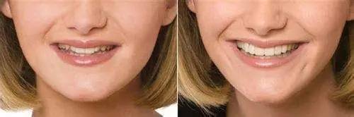 30岁淡化法令纹用什么精华,法令纹严重推荐精华