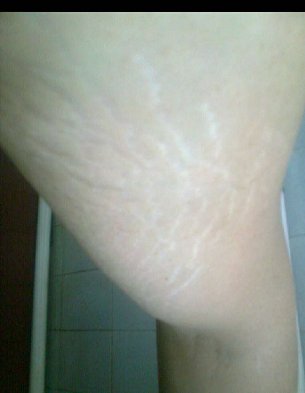 肥胖纹怎么消除产后,肥胖纹怎么消除涂什么药