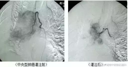 不可不知：六大肿瘤微创诊疗技术