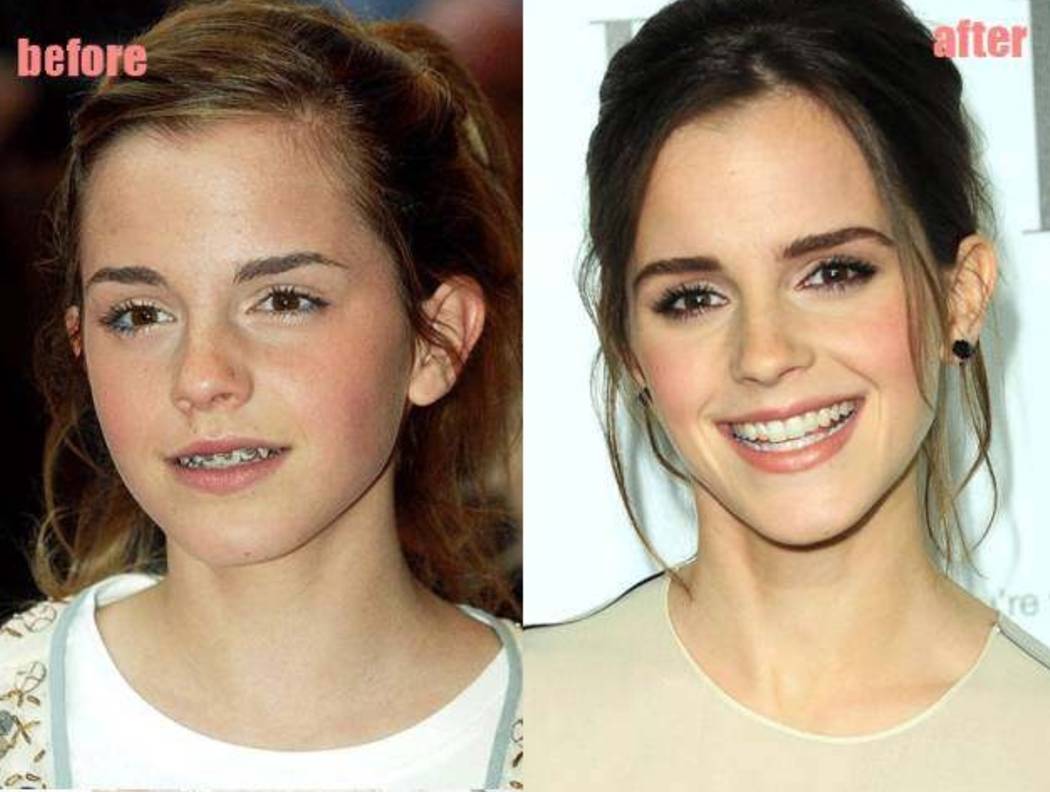 30岁淡化法令纹用什么精华,法令纹严重推荐精华