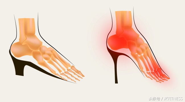 脚的拇指外翻老是磨成老茧怎么办,治疗脚大拇指外翻有什么好办法