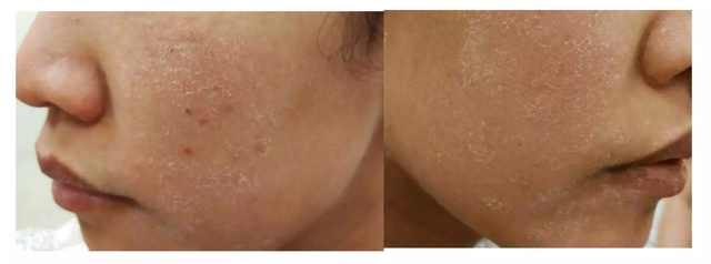 激素依赖性皮炎怎么算彻底修复好,激素依赖性皮炎裸脸会自愈吗