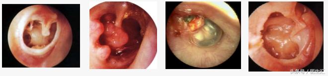 听力低频下降怎么恢复,低频听力下降耳鸣怎么治疗