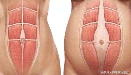 腹直肌分离自测图解是什么意思,腹直肌分离5厘米需要做治疗吗