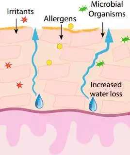 激素依赖性皮炎怎么算彻底修复好,激素依赖性皮炎裸脸会自愈吗