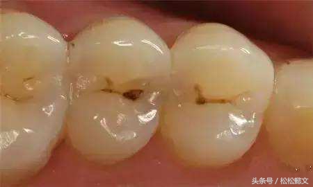 蛀牙为什么要治很多次,牙齿蛀牙高发如何有效预防和治疗